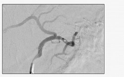 Figure 3. Postembolization selective left gastric arteriogram demonstrates “pruning” of the arterial branches consistent with successful embolization.