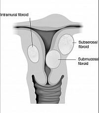 Types of Uterine Fibroids