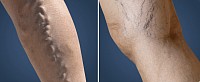 (Left) Varicose veins and on the (Right) Spider veins